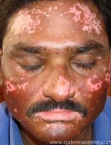 Vitiligo-After